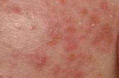 西宁市看皮炎的医院