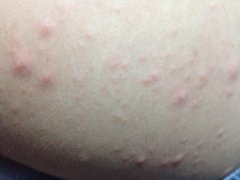 西宁治疗皮炎哪家医院较好